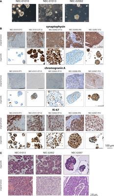 Patient-Derived Organoid Models of Human Neuroendocrine Carcinoma